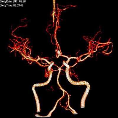 снимок КТ ангиографии головного мозга